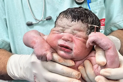 Miracle Baby Born Holding Contraceptive Coil That Failed: Doctor Shares 3 Stunning Photos Breaking the Internet